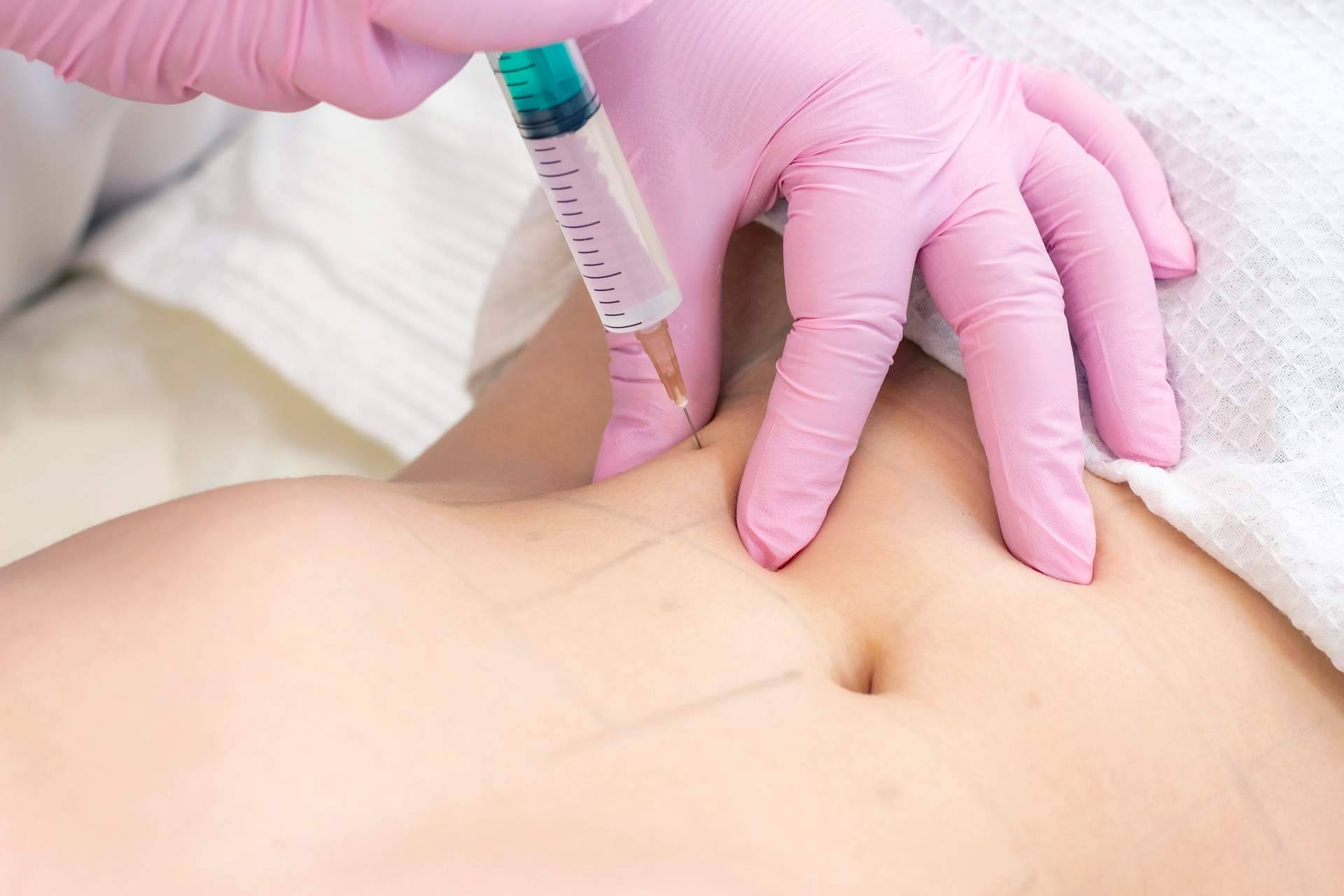 Alluring Clinic lleva a cavo mesoterapia efectiva contra la celulitis