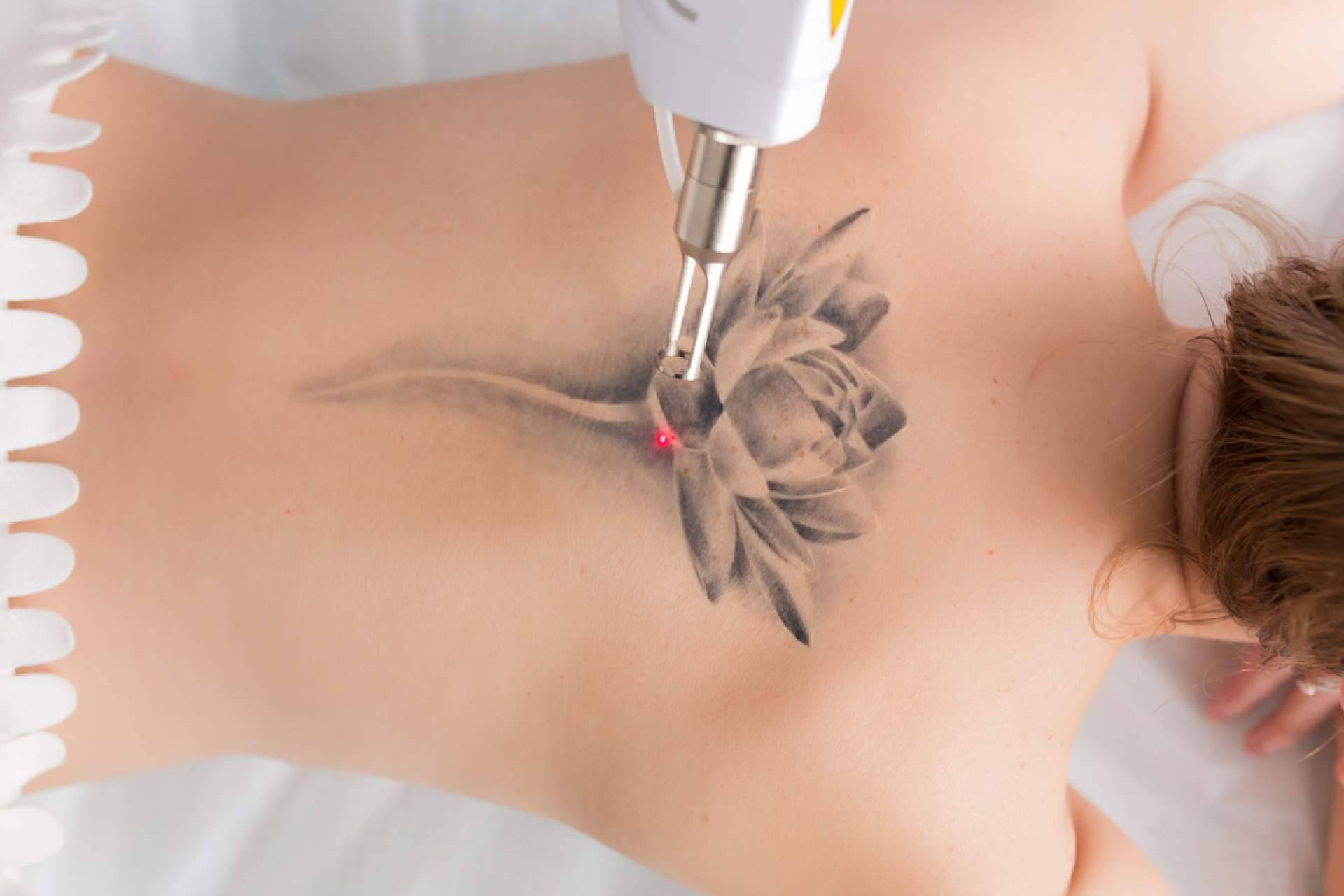 Centro Médico El Pilar dispone de las últimas tecnologías para eliminar tatuajes