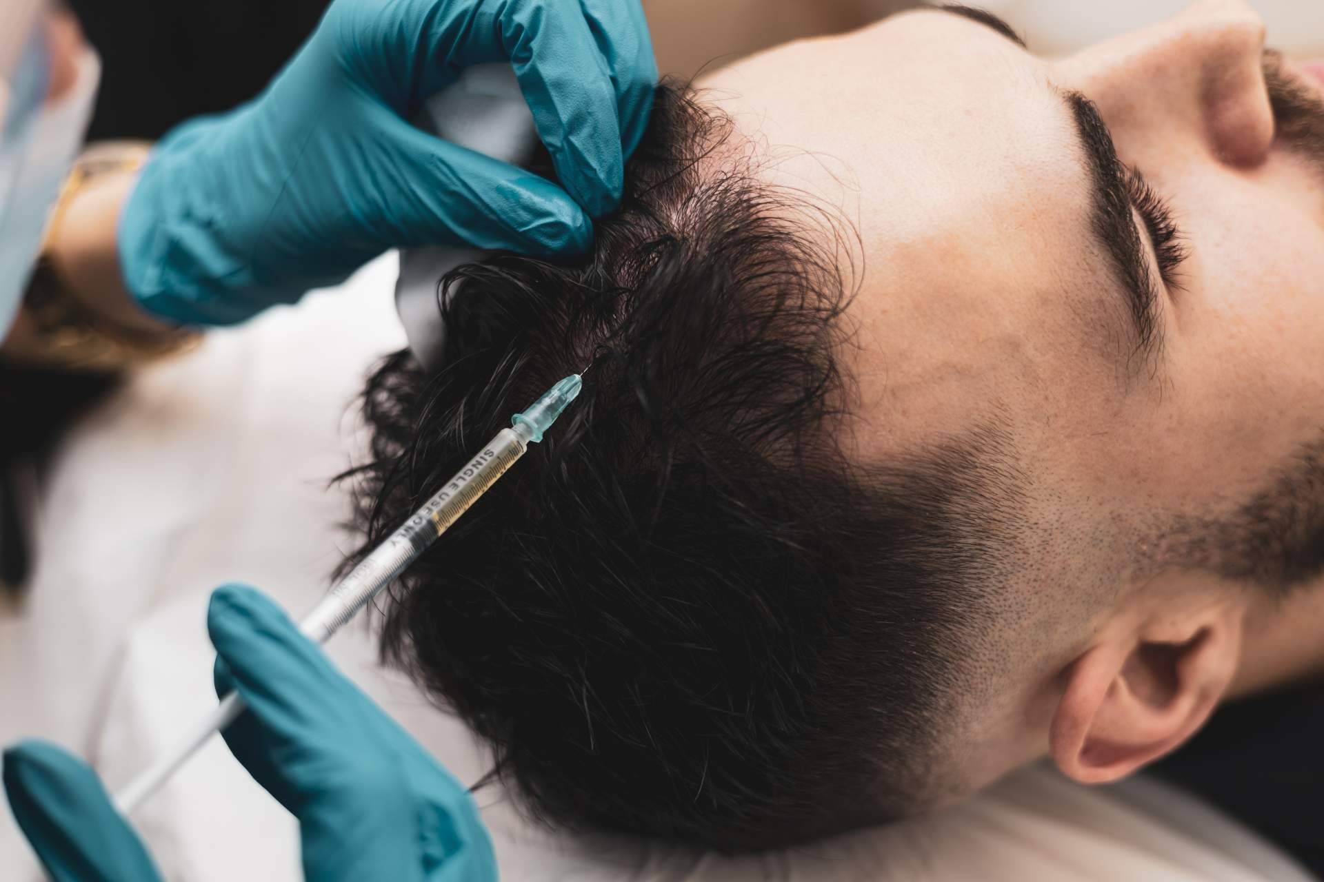 Poner fin a la caída del cabello con el tratamiento de mesoterapia capilar de Capilar Innovation Clinic, junto a su experto doctor Jesús Mora