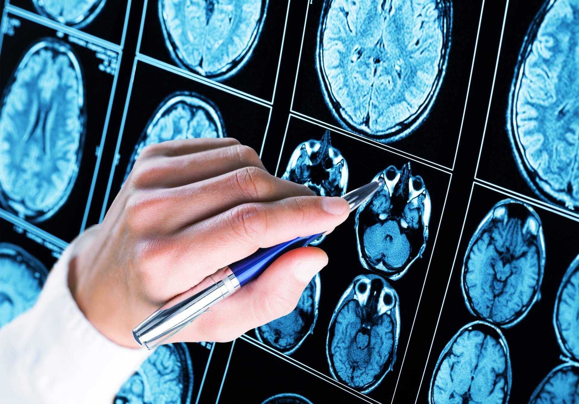 La enfermedad de Alzheimer, su cura se hace esperar, aunque se avanza