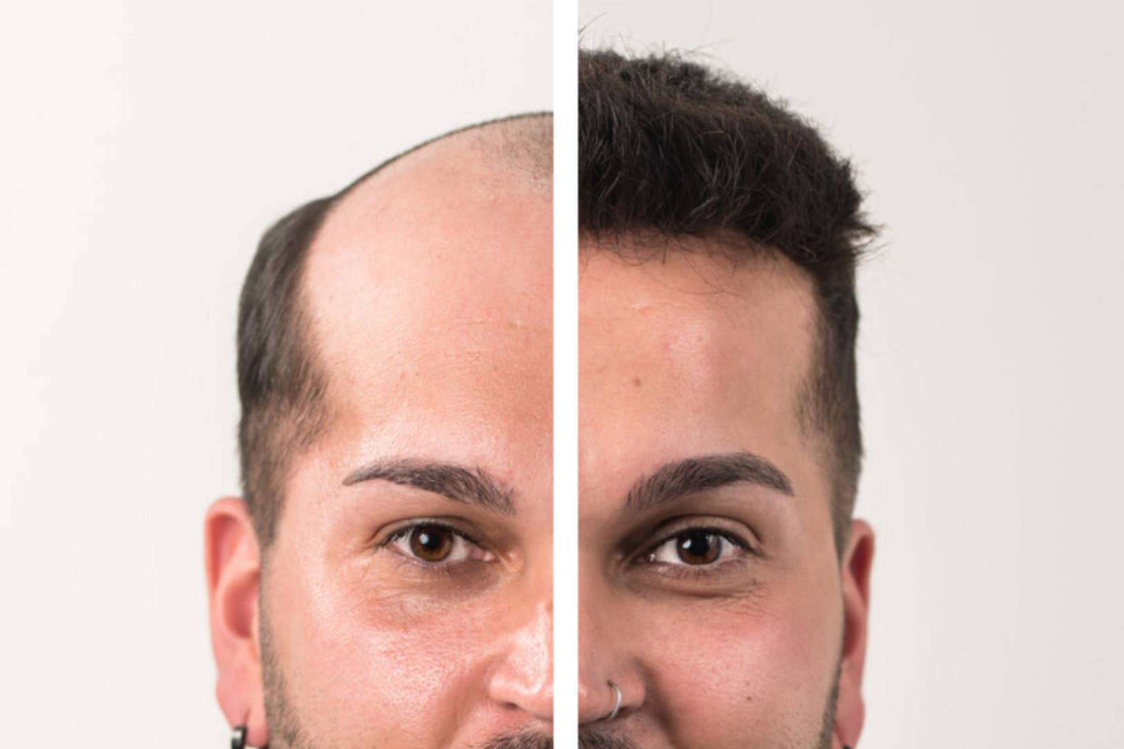 Las prótesis capilares para hombre, un mercado en auge, con Hair Inspira