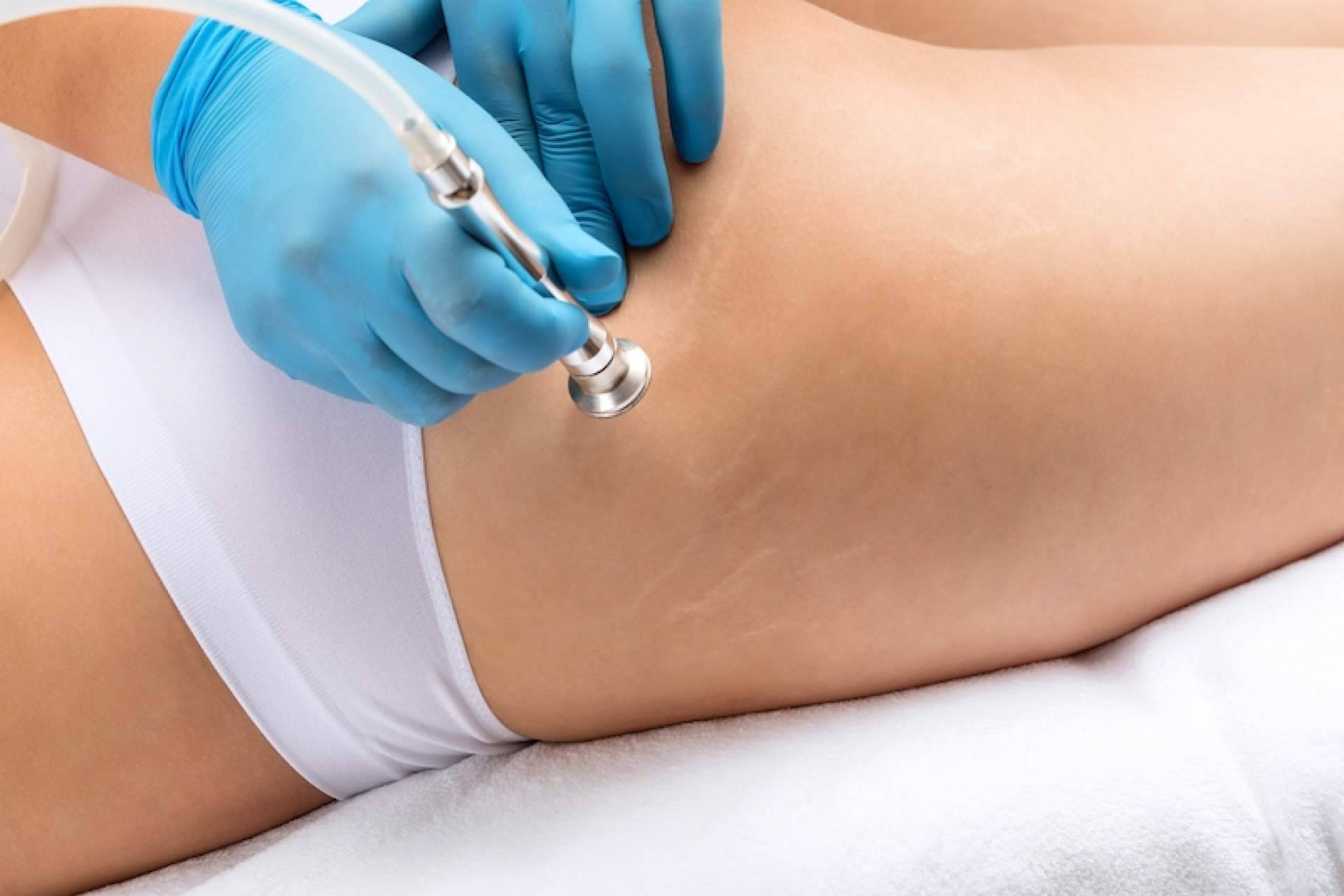 ¿Cuáles son las ventajas de eliminar estrías?, con la Clínica Estética Pilar