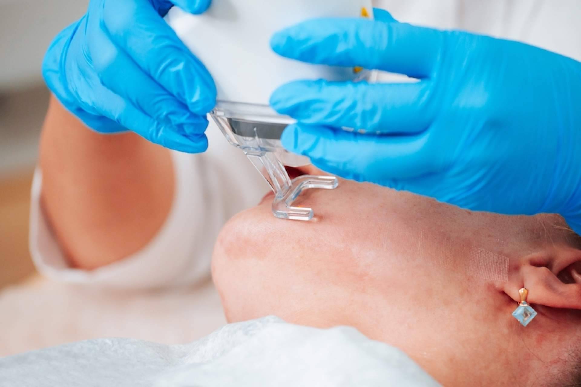 Las ventajas de usar tratamientos para eliminar cicatrices, con Centro Estética el Pilar