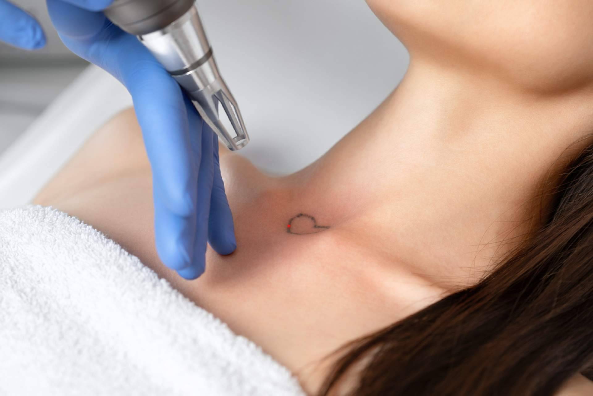 Eliminar tatuajes a color ya es posible en Ink Láser Alicante