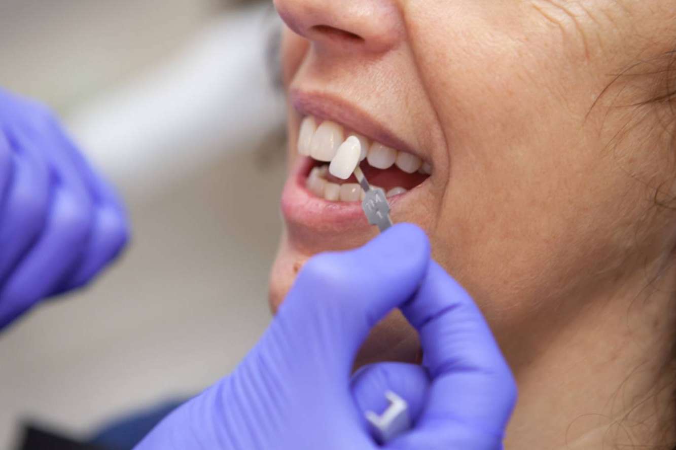 Aplicación de carillas dentales, con los especialistas de CLÍNICA CRISTINA VIYUELA + CO