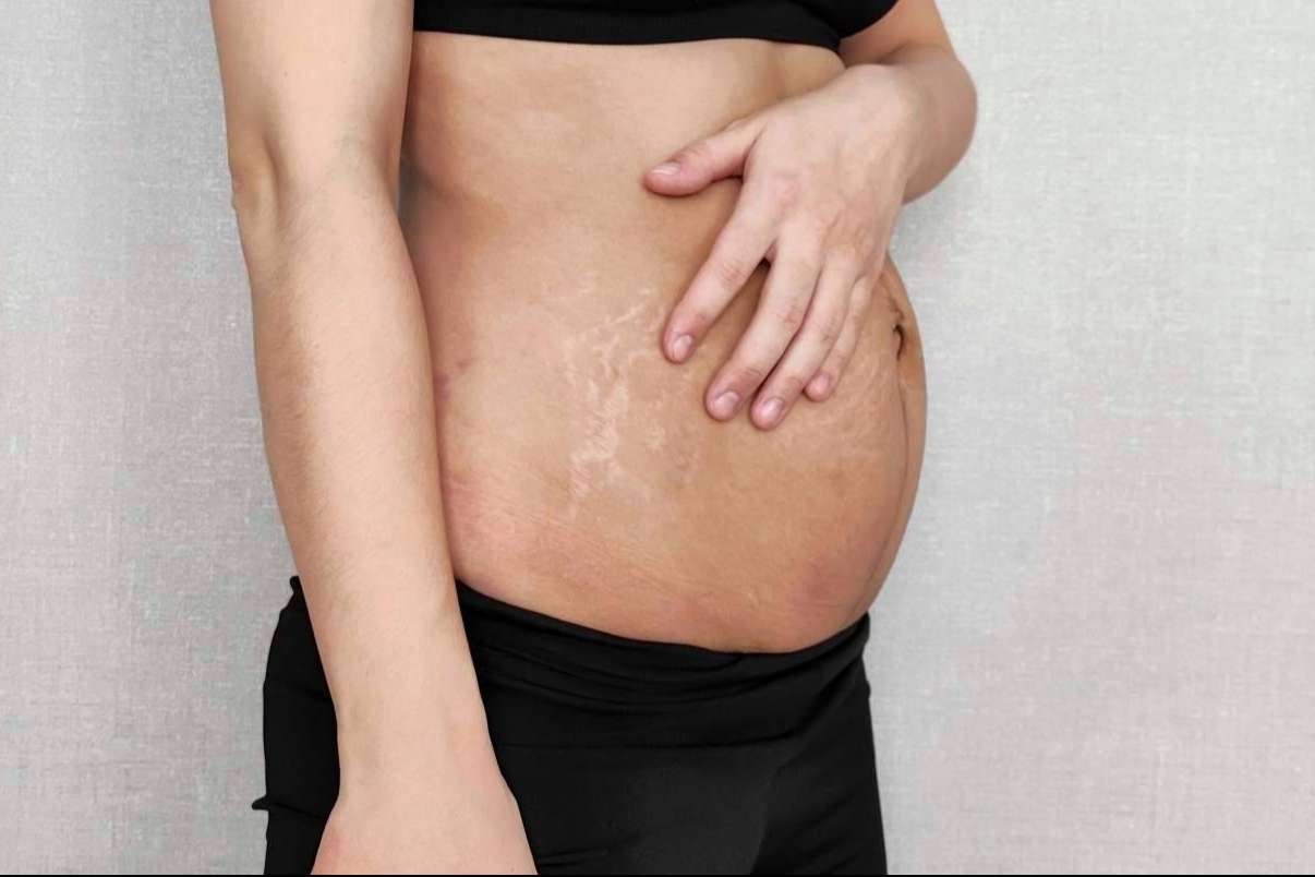 ¿Por qué es importante una buena recuperación posparto para el suelo pélvico?
