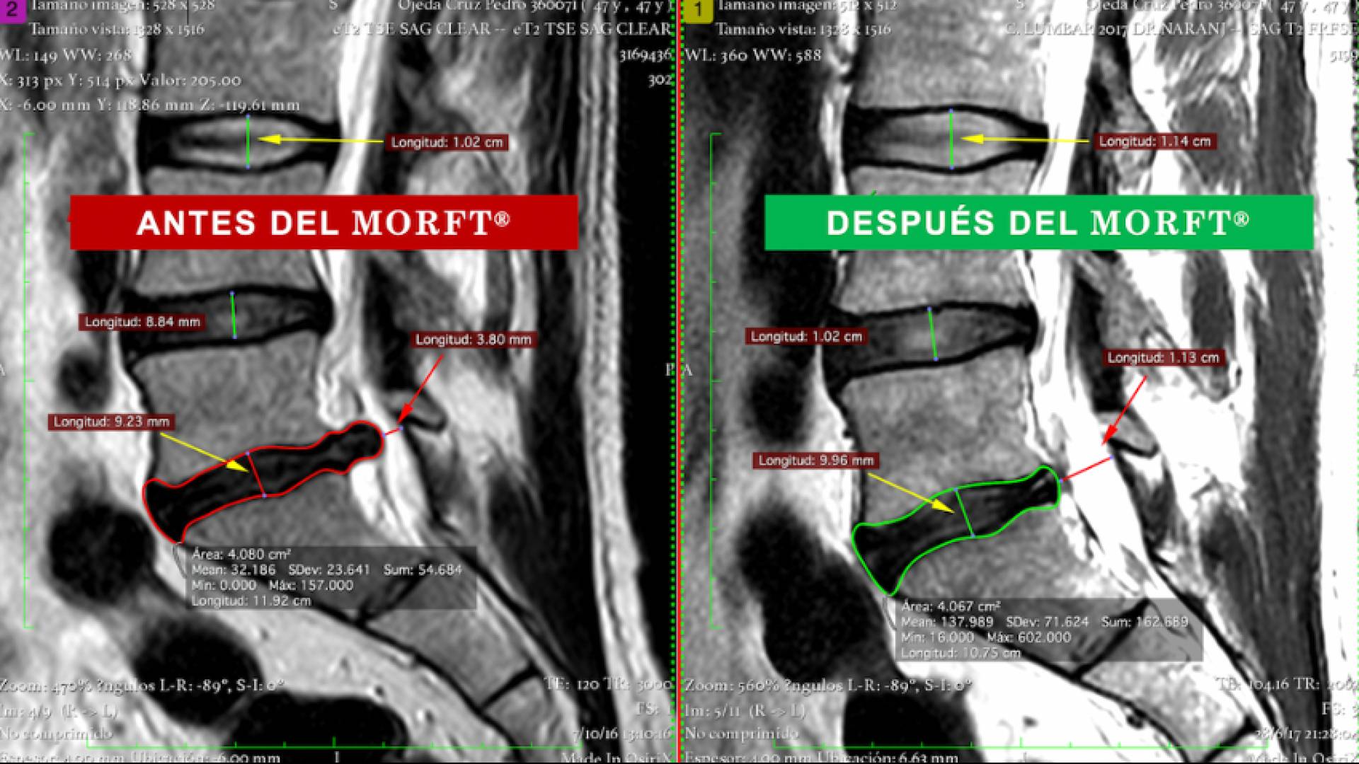 El método MORFT® rehabilita sin medicamentos ni cirugías a pacientes que viven con protusión y/o hernia discal