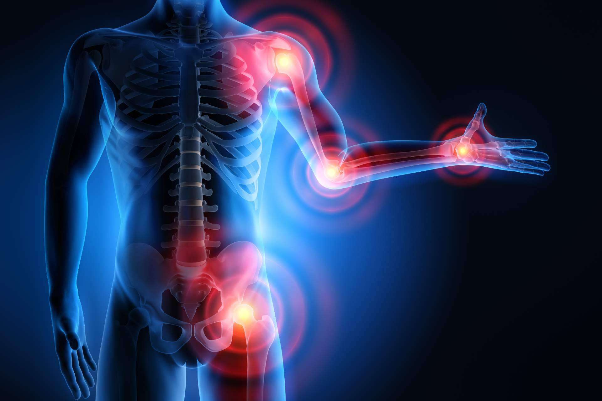 Phytogen Medical Foods ofrece un tratamiento para la osteoartritis