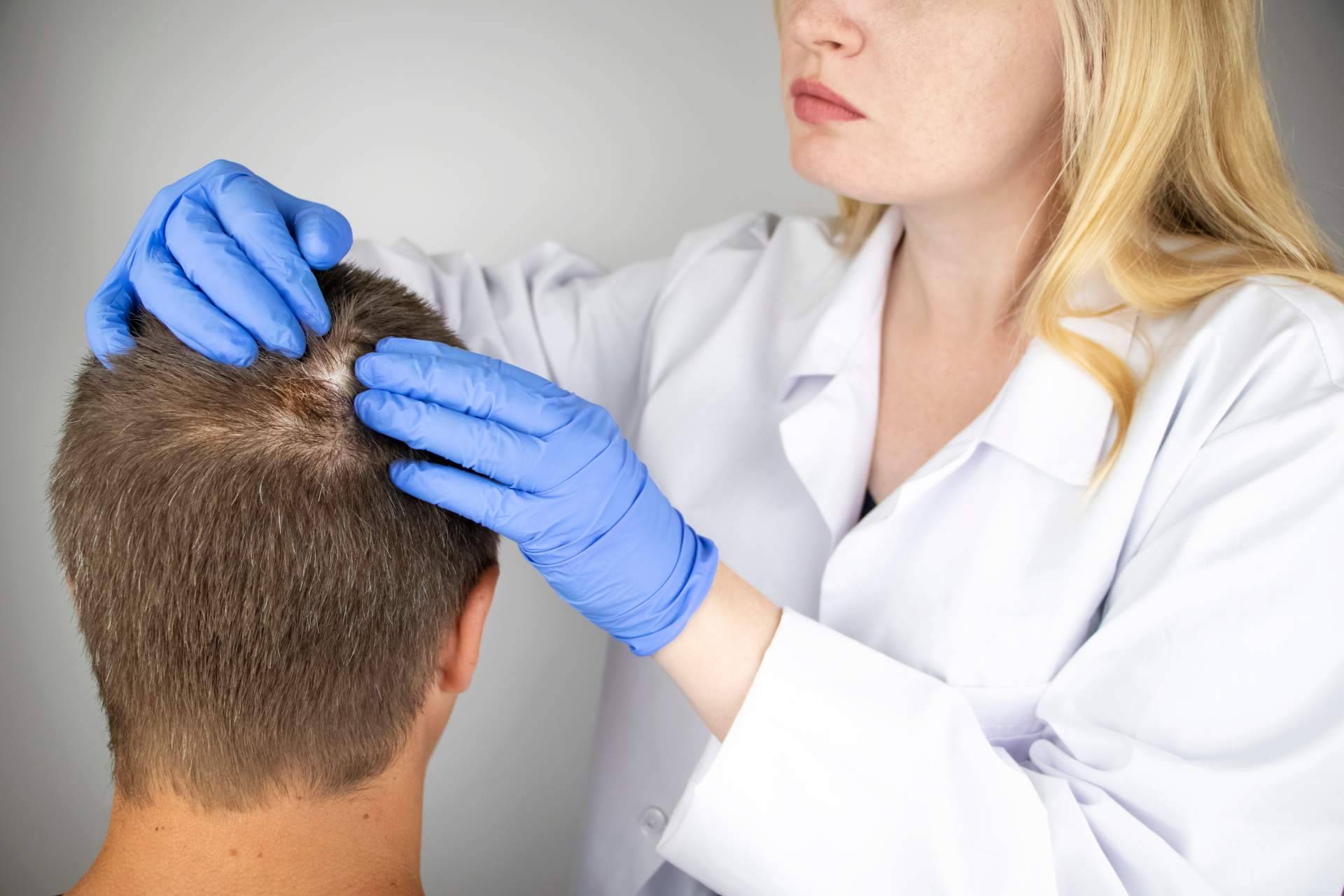 ¿Cuáles son los tratamientos para la alopecia androgénica de Saw Palmetto?