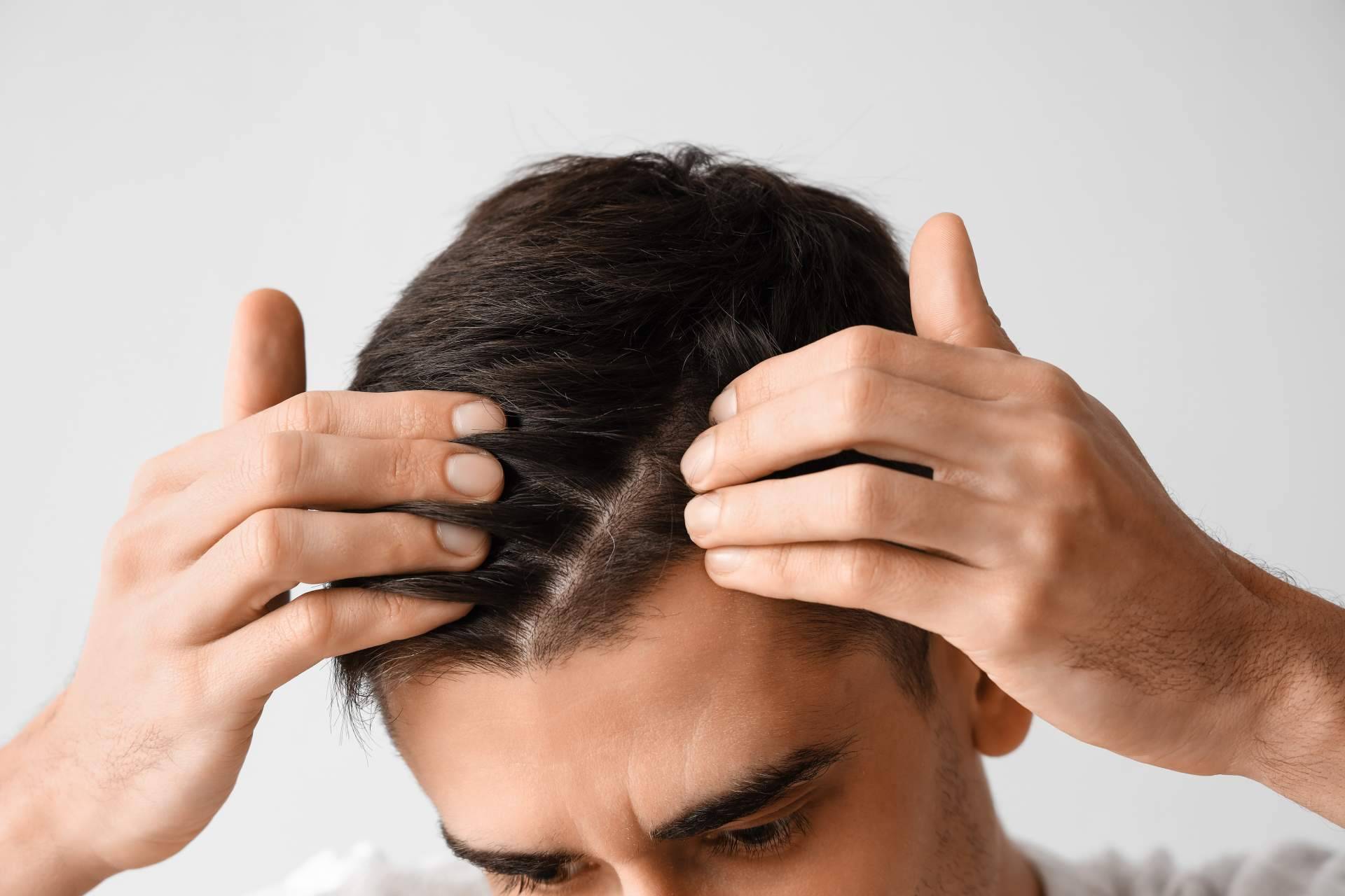 Xpecia hombre, una solución para combatir la alopecia