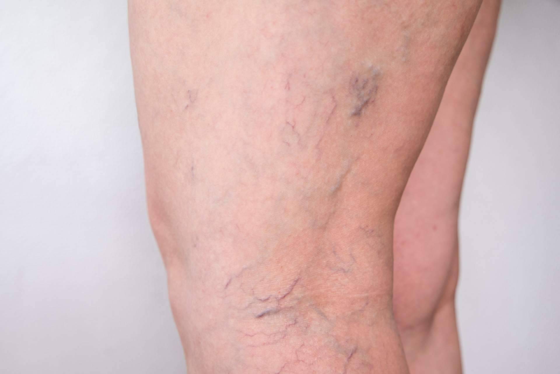 Los especialistas en la eliminación de varices de Elegansse