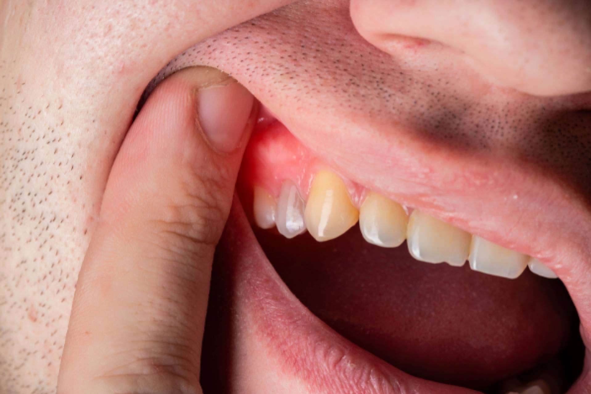 Prevención y tratamiento de enfermedades de las encías, con Denty Dent