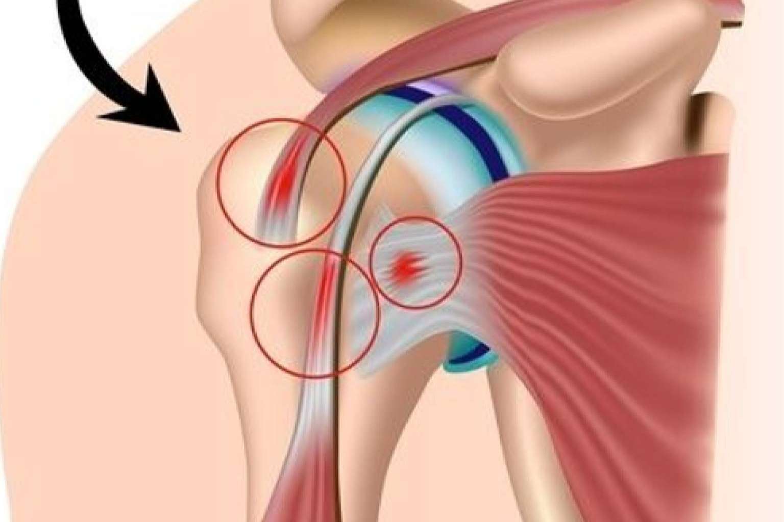 Dolor de hombro; tratamiento eficaz con plasma rico en plaquetas y células madre, en Biorigenera