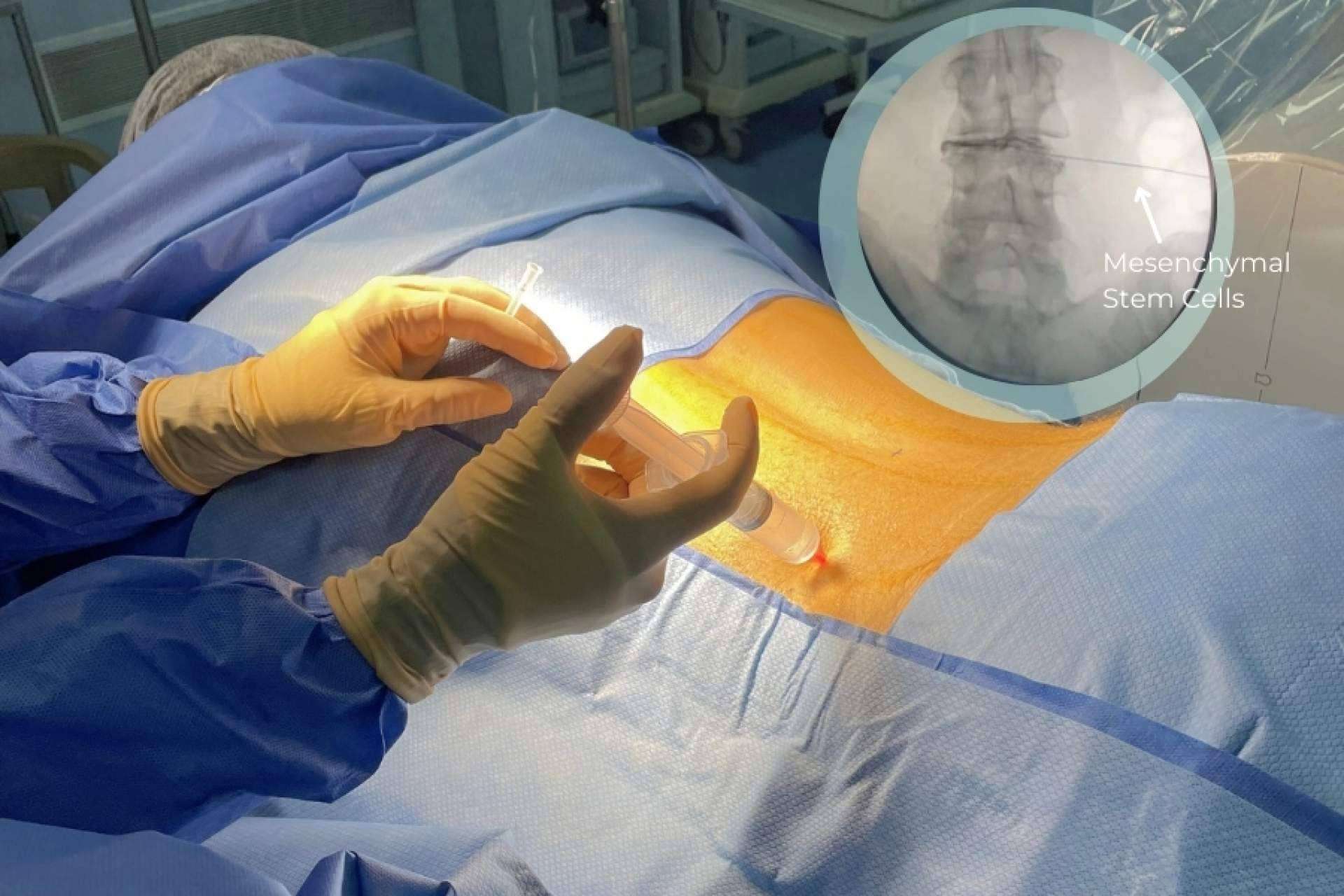 Immunotherapy Regenerative Medicine, tratamientos de hernias discales duraderos mediante células madre