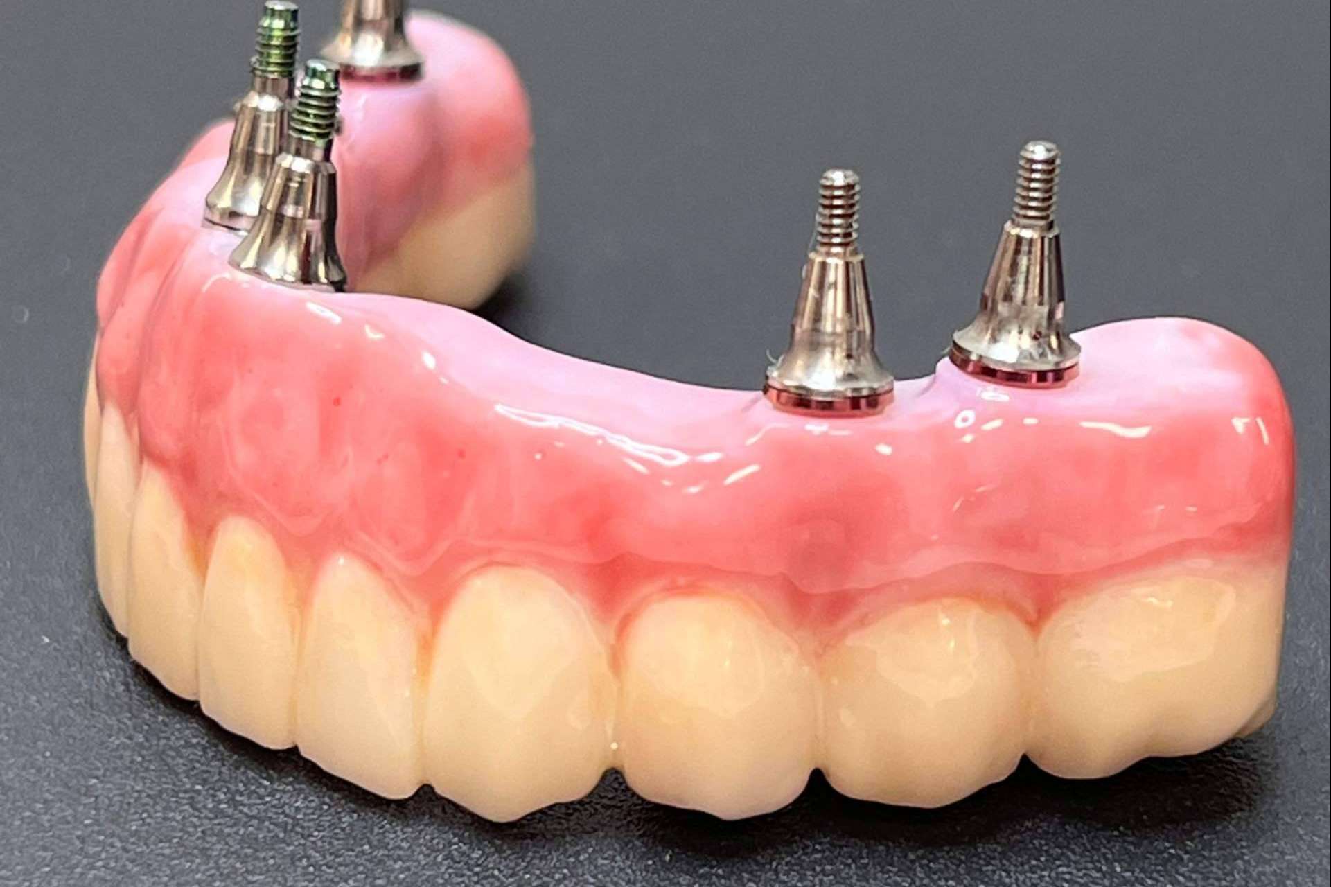Implantes dentales y extracciones en una misma visita