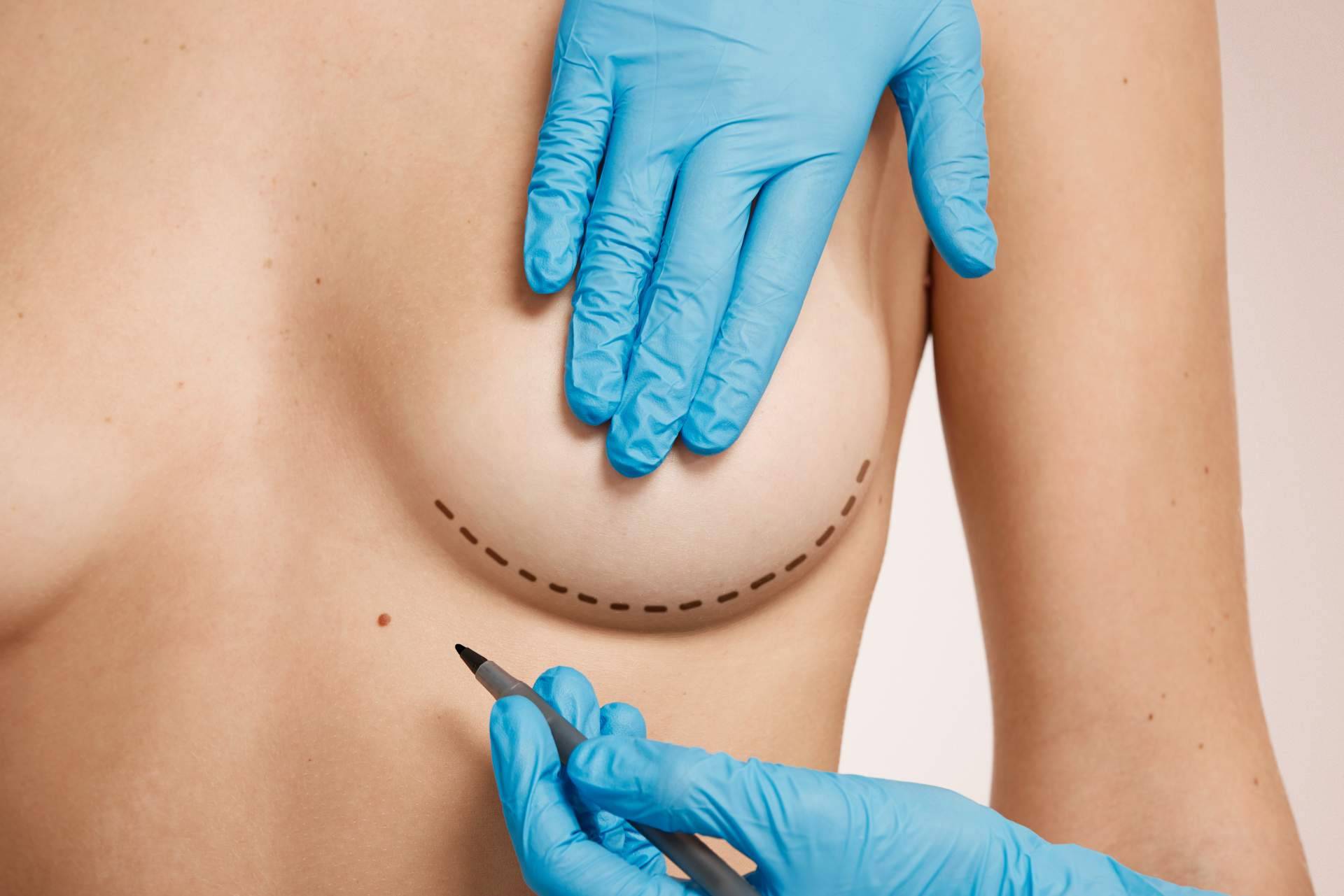 Las clínicas de cirugía estética Beauty & Beauty ofrecen una solución a las mamas tuberosas o tubulares