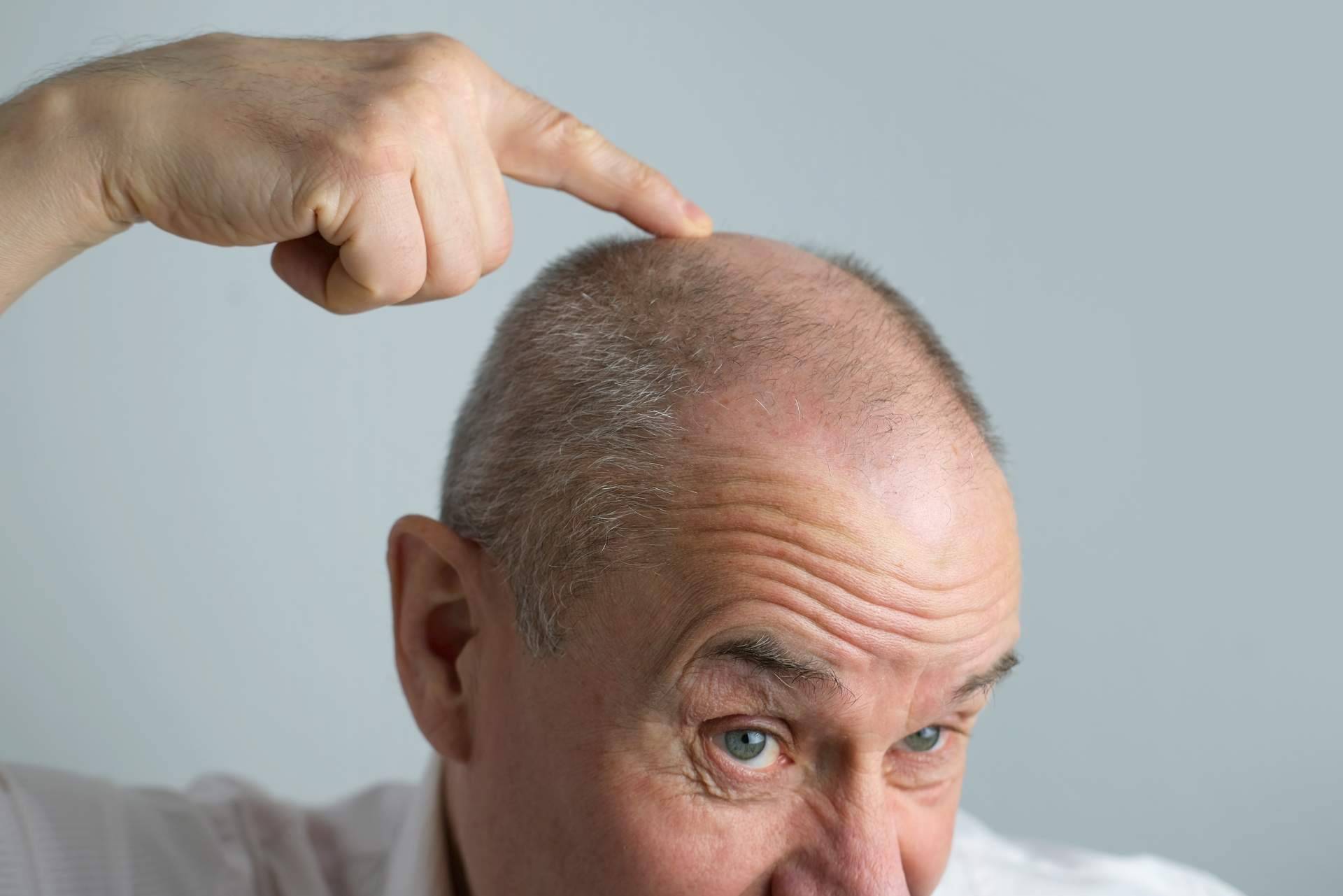 Xpecia Hombre combate la alopecia androgénica con una fórmula específica para frenar la caída del cabello
