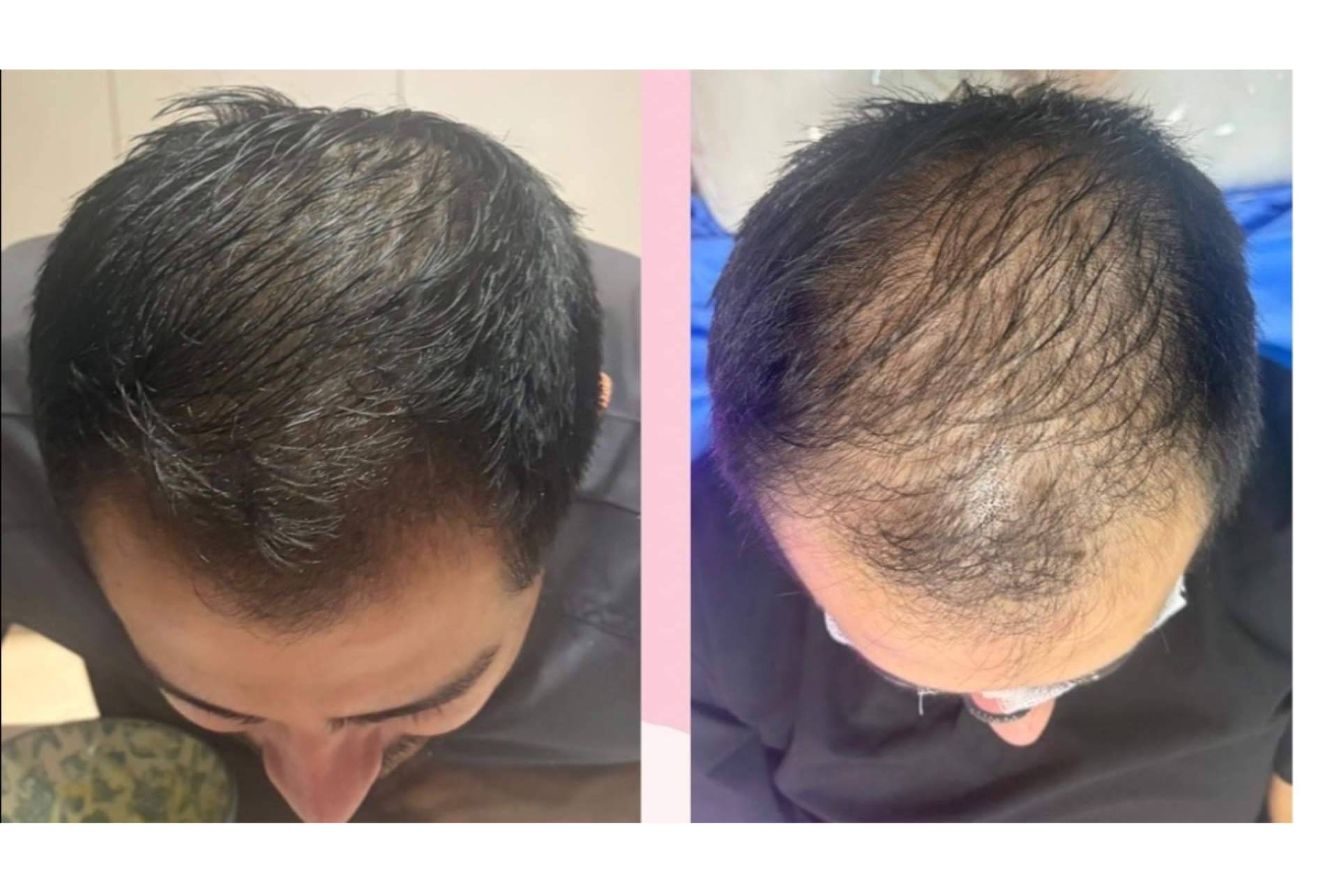 Alopecia androgenética, las novedades que marcarán el abordaje de la caída de cabello en 2027